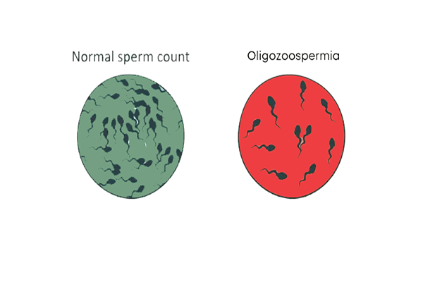 Low Sperm Count
										(Oligospermia)